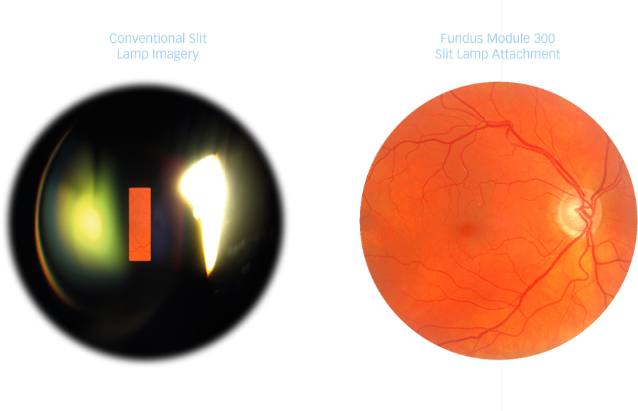 Fundus Comparison